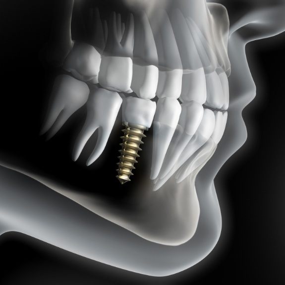 dental implant diagram